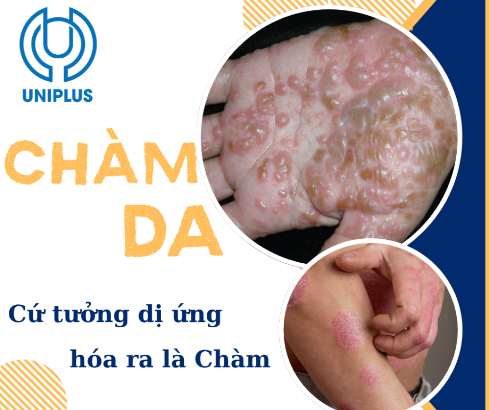 Chàm Da là gì?  Căn Bệnh Ngứa Kinh Niên Khiến Nhiều Người Mệt Mỏi – Cách Điều Trị Đúng Ngay Từ Đầu