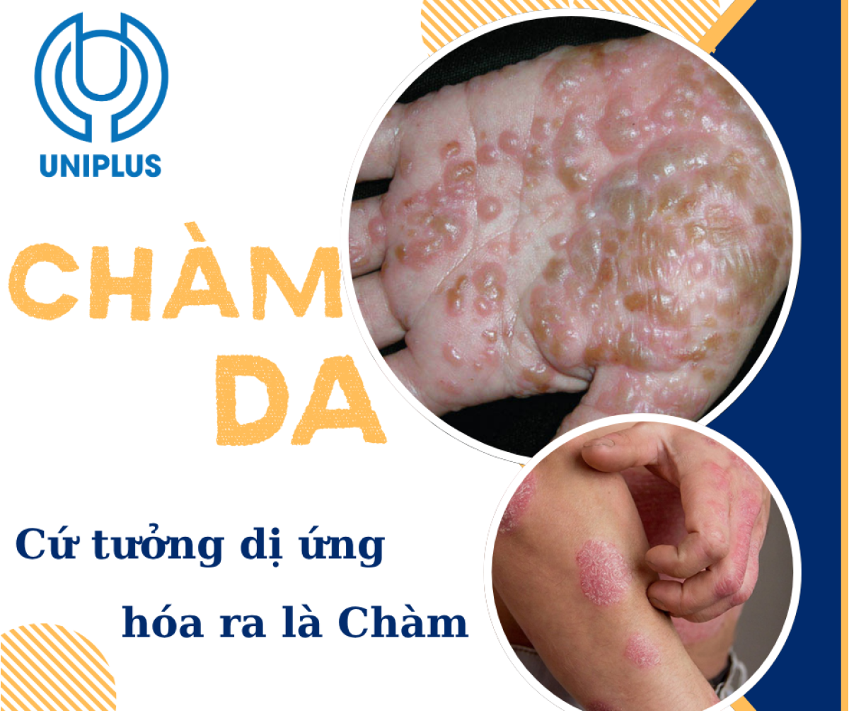 Chàm Da là gì? Căn Bệnh Ngứa Kinh Niên Khiến Nhiều Người Mệt Mỏi – Cách Điều Trị Đúng Ngay Từ Đầu
