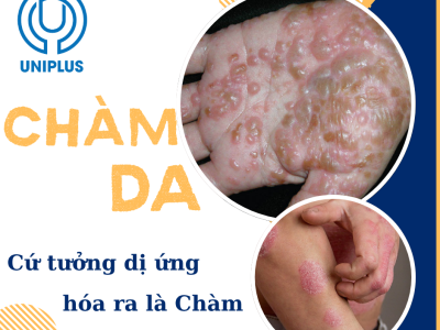 Chàm Da là gì?  Căn Bệnh Ngứa Kinh Niên Khiến Nhiều Người Mệt Mỏi – Cách Điều Trị Đúng Ngay Từ Đầu