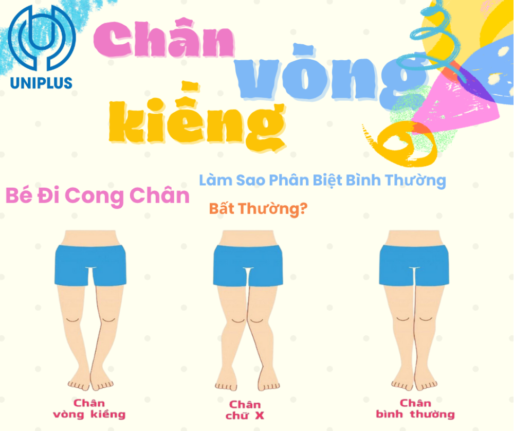 Chân Vòng Kiềng Ở Trẻ Không Còn Là Nỗi Lo – Cách Điều Chỉnh An Toàn Ngay Từ Nhỏ