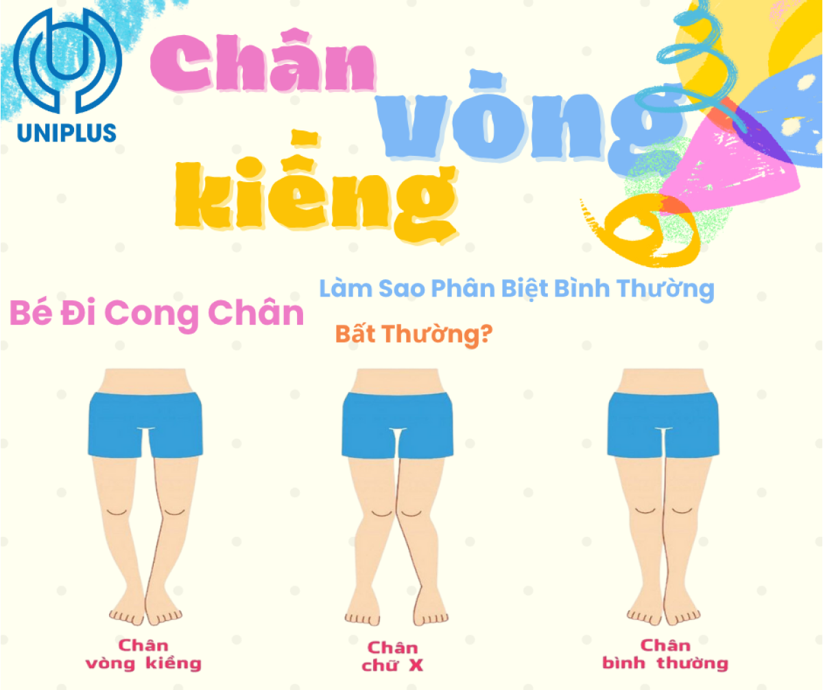 Chân Vòng Kiềng Ở Trẻ Không Còn Là Nỗi Lo – Cách Điều Chỉnh An Toàn Ngay Từ Nhỏ