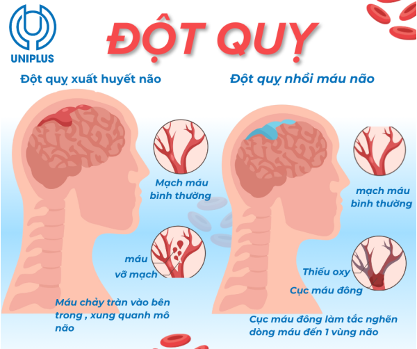 Đột quỵ là gì? Dấu hiệu nhận biết, thời gian vàng và cách xử trí đúng khi gặp người bị đột quỵ Đột quỵ là gì? Dấu hiệu nhận biết, thời gian vàng và cách xử trí đúng khi gặp người bị đột quỵ