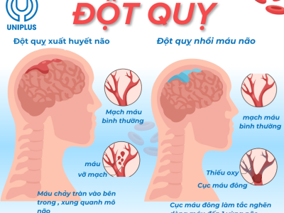 Đột quỵ là gì? Dấu hiệu nhận biết, thời gian vàng và cách xử trí đúng khi gặp người bị đột quỵ