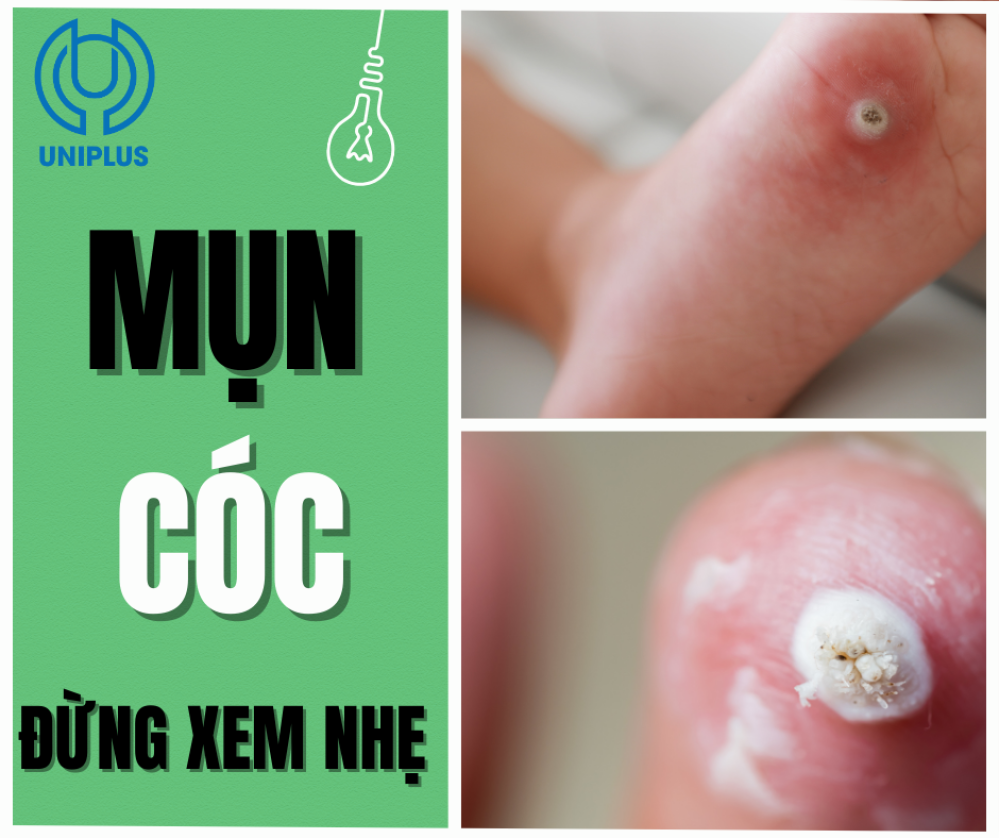 Mụn cóc – Dấu hiệu nhỏ nhưng tiềm ẩn nguy cơ lớn mà ít ai biết ? 