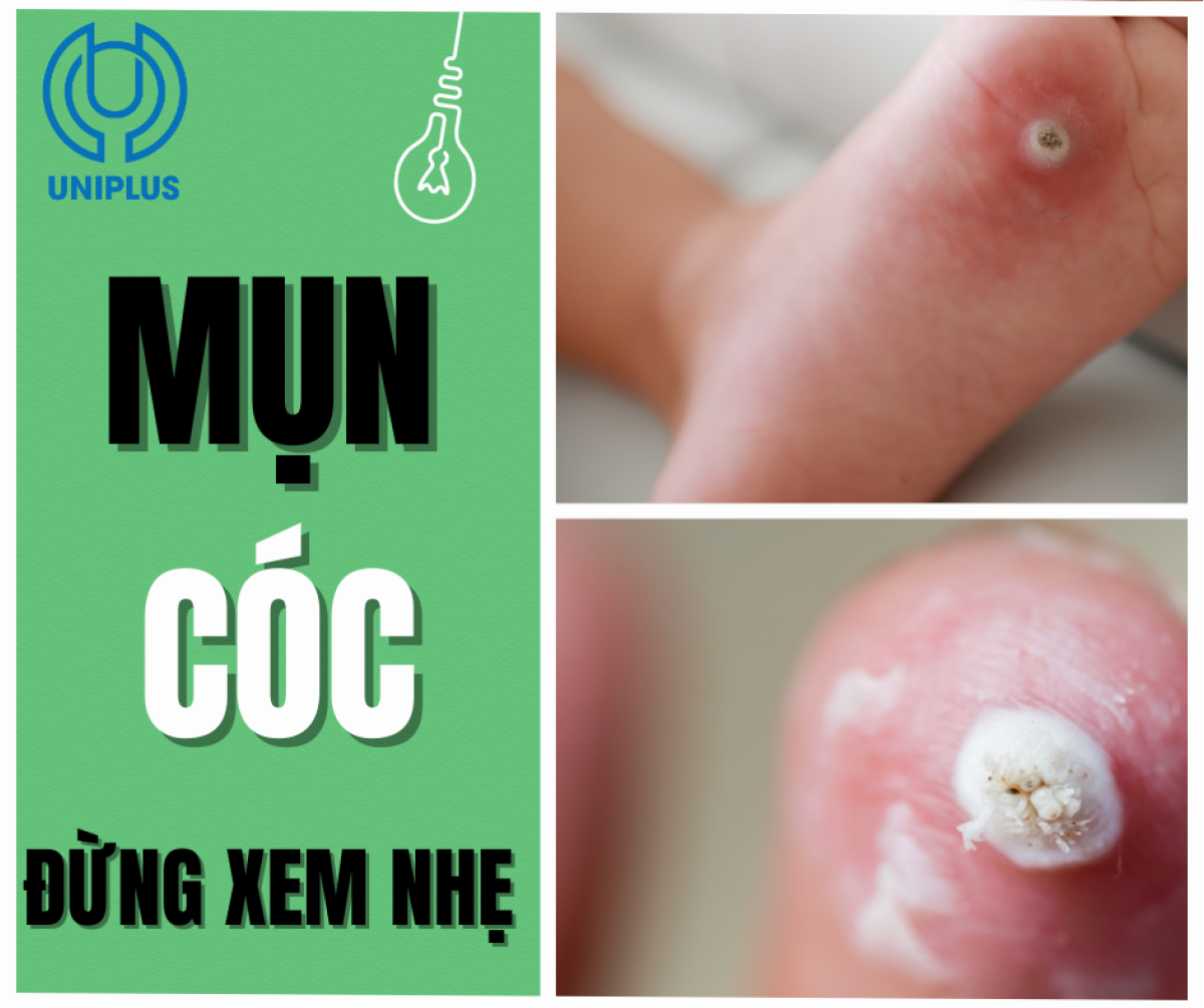 Mụn cóc – Dấu hiệu nhỏ nhưng tiềm ẩn nguy cơ lớn mà ít ai biết ? 