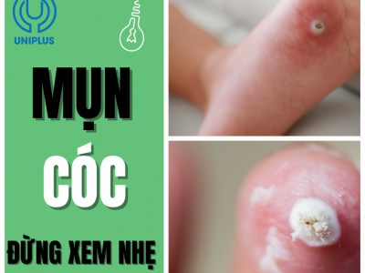Mụn cóc – Dấu hiệu nhỏ nhưng tiềm ẩn nguy cơ lớn mà ít ai biết ? 