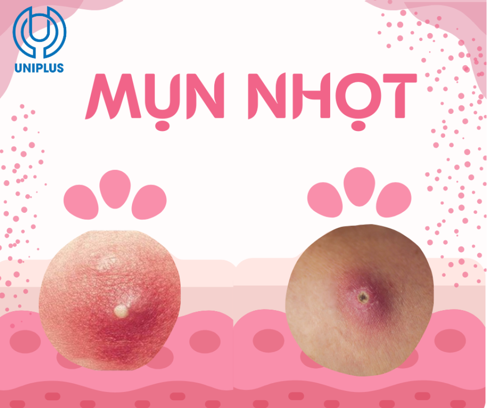 Mụn nhọt và cách chăm sóc mụn tại nhà 