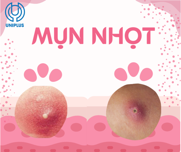 Mụn nhọt và cách chăm sóc mụn tại nhà 