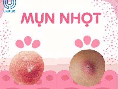 Mụn nhọt và cách chăm sóc mụn tại nhà 