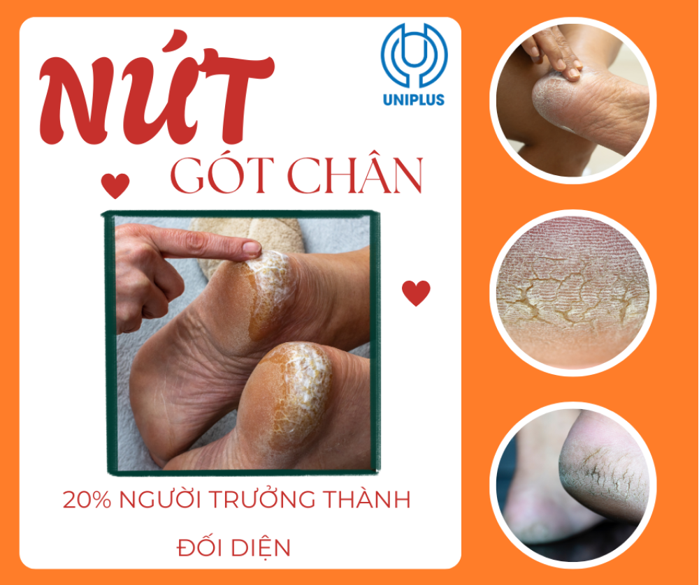 Sự thật đáng sợ đằng sau những vết nứt gót chân: Không chỉ là khô da thông thường
