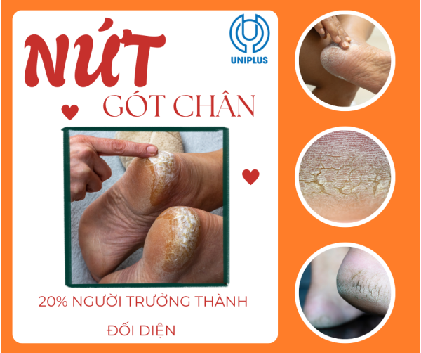 Sự thật đáng sợ đằng sau những vết nứt gót chân: Không chỉ là khô da thông thường Sự thật đáng sợ đằng sau những vết nứt gót chân: Không chỉ là khô da thông thường