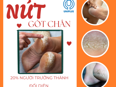 Sự thật đáng sợ đằng sau những vết nứt gót chân: Không chỉ là khô da thông thường