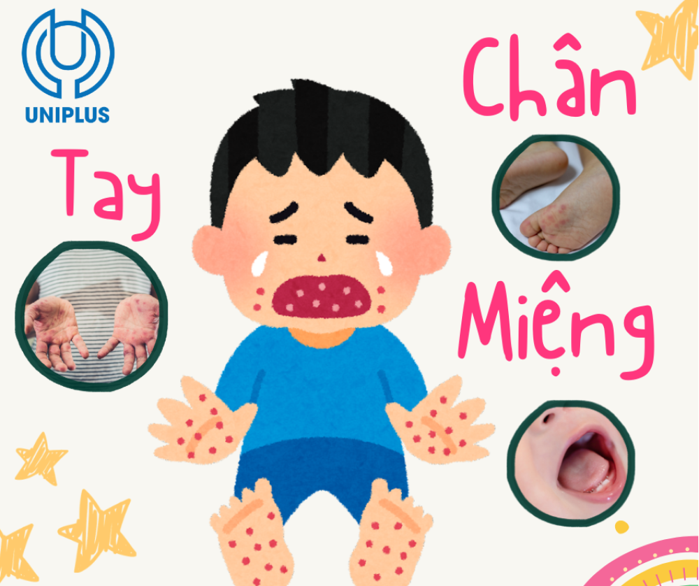 Bệnh Tay Chân Miệng - Hiểu đúng để bảo vệ con yêu Bệnh Tay Chân Miệng - Hiểu đúng để bảo vệ con yêu