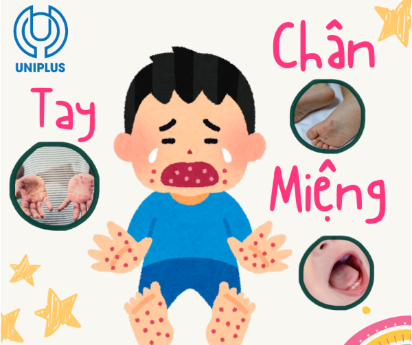 Bệnh Tay Chân Miệng - Hiểu đúng để bảo vệ con yêu 